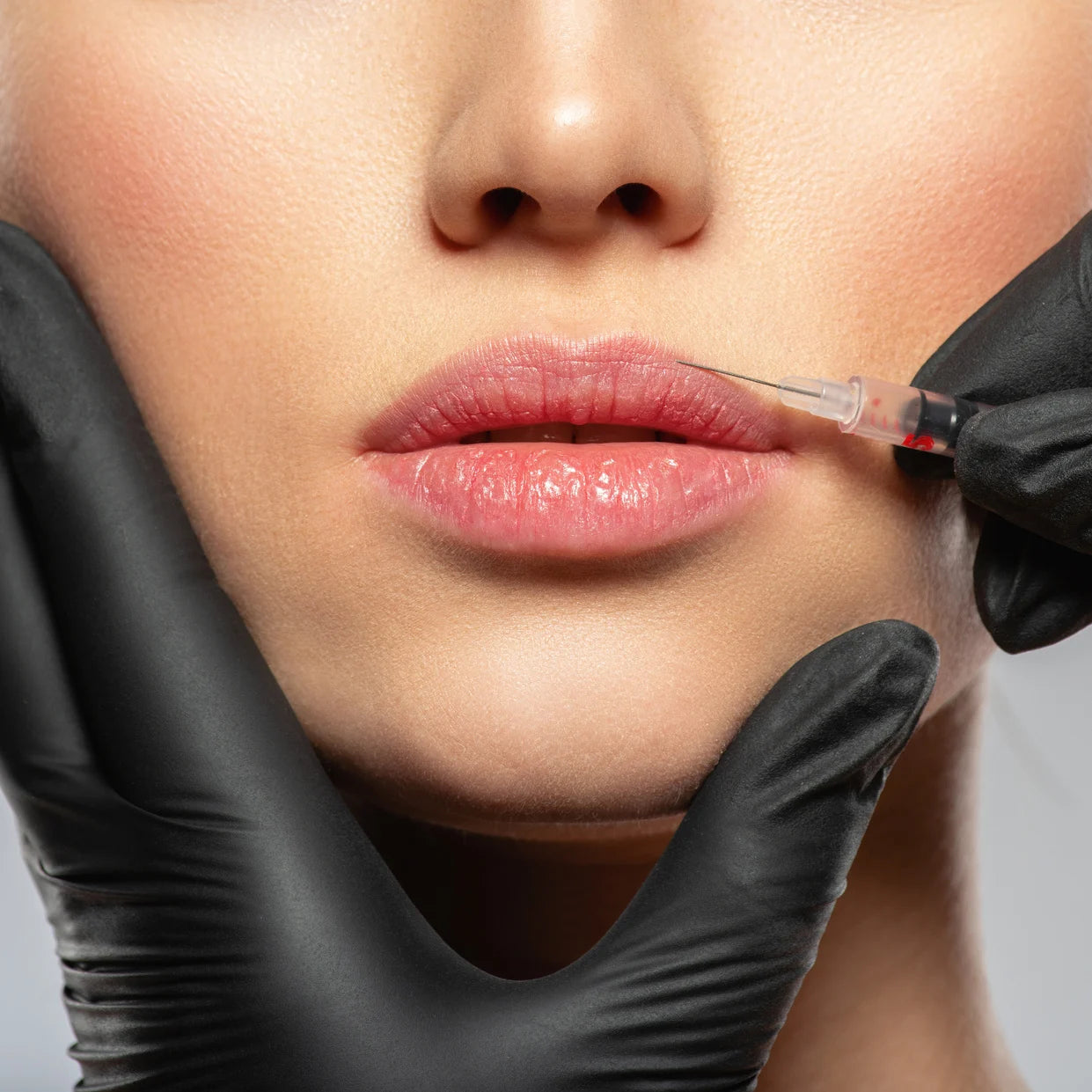 woman having lip fillers injection