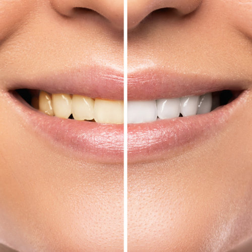 before and after image of teeth whitening treatment