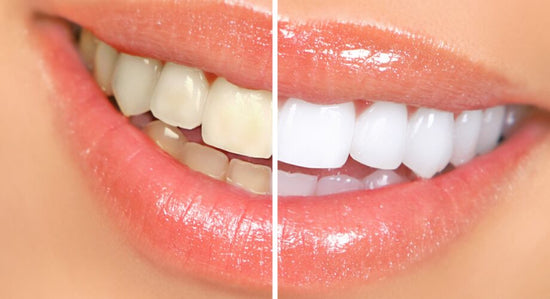 mouth showing before and after teeth whitening treatment
